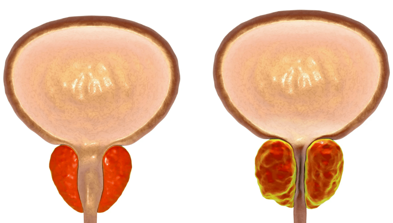 Простатит чист